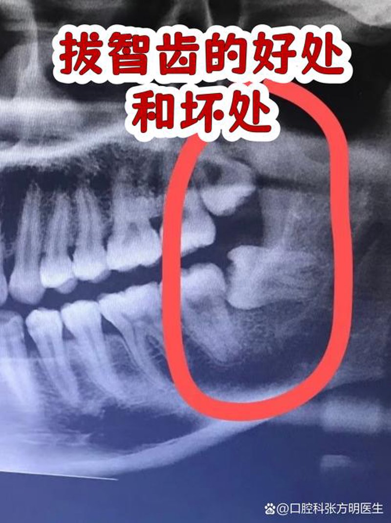 拔智齿
