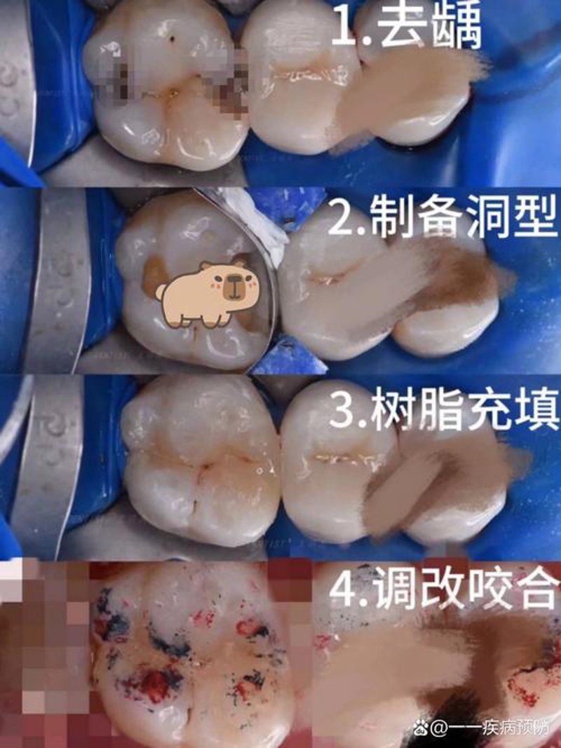 种植牙价格解析：你了解多少？
