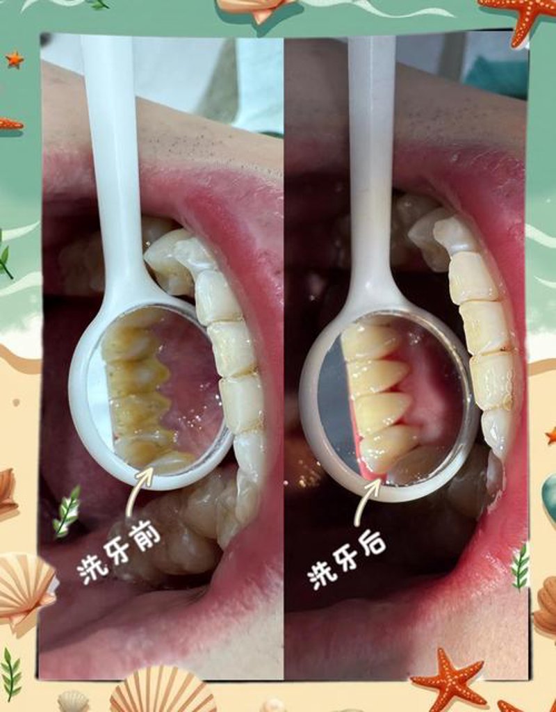 解读种植牙价格：如何选择适合自己的治疗方案